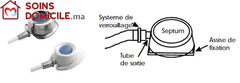  La chambre implantable ou chambre à cathér implantable est un réservoir d’accès vasculaire central, implanté sous la peau, pour l’injection de médicaments à domicile sur la chambre implantable.