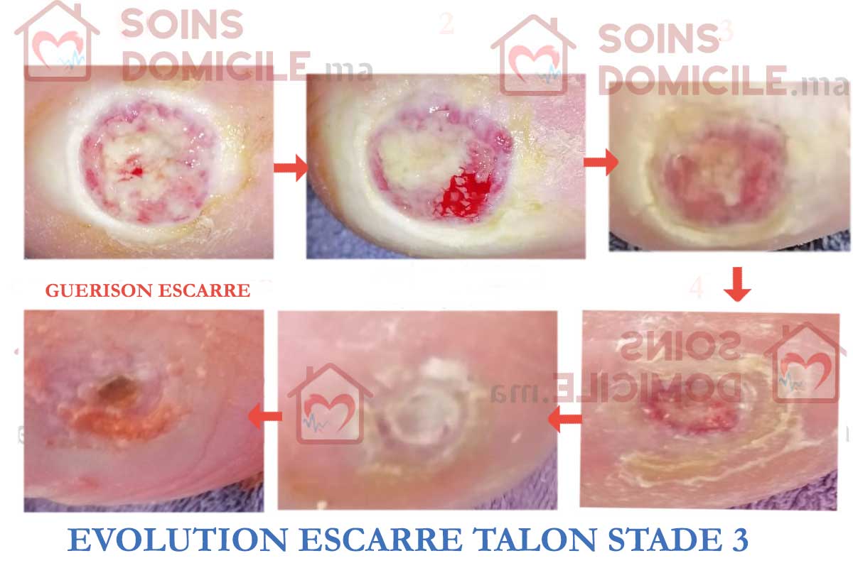 Les escarres du talon sont très douloureuses, et peuvent limiter sévèrement la mobilité, voire même conduire à des amputations chez les patients atteints de diabète.<br />
D’après le cours de notre enseignante sur les escarres, celle-ci est survenue suite à des facteurs intrinsèques tels que l’immobilisation prolongée de la patiente. En effet, Mme L. est alitée et ne peut être mobilisée. Elle est dans le refus de soins et même d’alimentation ; la dénutrition étant également un facteur favorisant, la pose d’une sonde de jéjunostomie pour alimentation entérale par laparotomie était prévue. Son diabète est également un problème car, souvent, ces patients ont une mauvaise circulation sanguine. L'escarre talonnière était de stade 4 avec exposition osseuse et les soins apportés n’avaient aucun effet. La patiente disposait d’un matelas à support dynamique à pression alternée et la décision du chirurgien fut l’amputation afin d’éviter que l’infection ne se propage dans les tissus mous et les os.