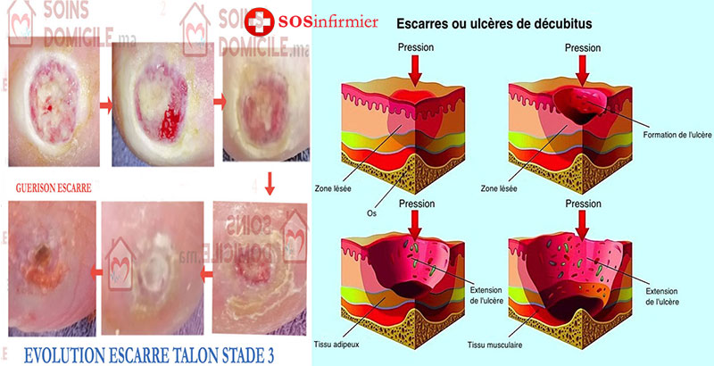 Soins escarre à domicile Casablanca