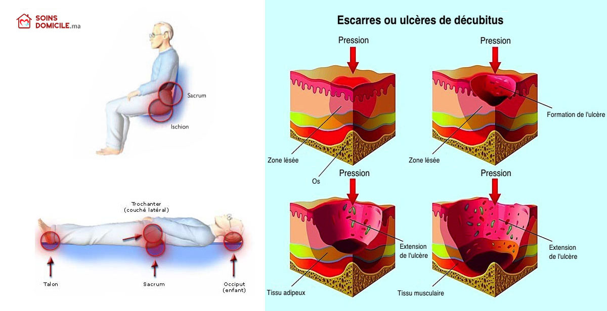 Prévention et traitement des escarres