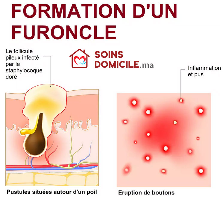 Le furoncle est une infection bactérienne de la peau. Il se caractérise par un bouton rouge et douloureux centré autour d’un poil. Il se transforme rapidement en pustule.