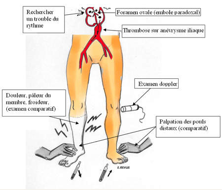 L’ischémie aigue est une urgence vasculaire et met en jeu le pronostic du membre (20 à 35 % de mortalité) en cas de retard thérapeutique.<br />
<br />
Le diagnostic est clinique, le traitement anticoagulant doit être débuté en milieu hospitalier et nécessite le plus souvent un geste de revascularisation.