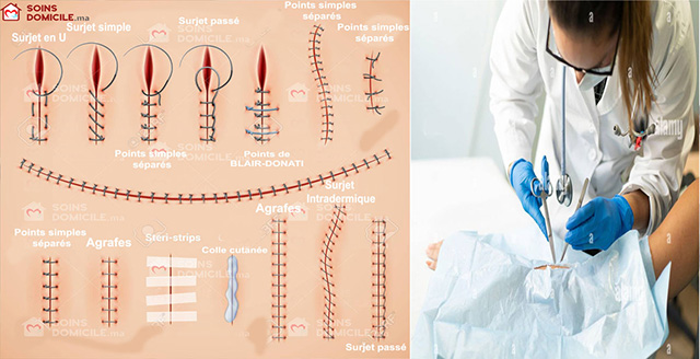 L’infirmier peut être amené, notamment aux urgences, à prendre en charge des blessés qui présentent des plaies nécessitant une suture. Quelles sont ses compétences dans ce domaine ?
Une compétence longtemps réservée aux infirmiers de bloc opératoire
Cette compétence suppose plusieurs savoir-faire :
identifier les différentes techniques de fermeture ;